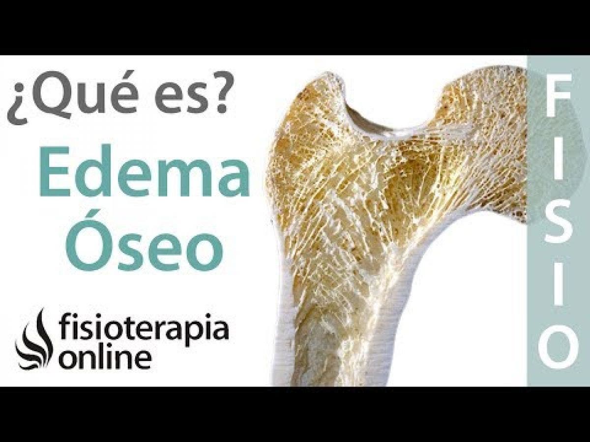 Tratamiento para edema oseo tobillo